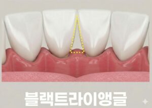 앞니 벌어짐