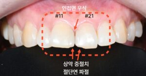 앞니 레진 깨짐