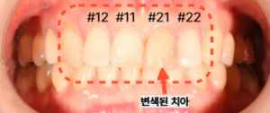 "상악 앞니 실활치 미백으로 변색 개선 중"