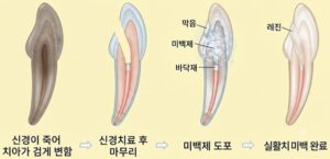 상악 앞니 임시치아 장착 및 치아 표면 준비
