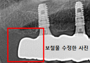 전악 임플란트 수술 장면