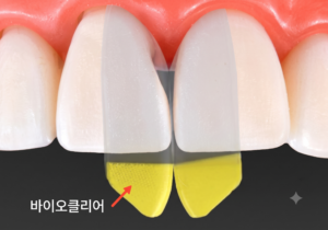 블랙트라이앵글 레진