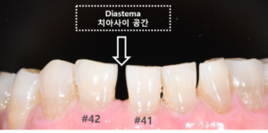 앞니 사이 공간 레진
