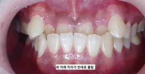성인 반대교합 교정