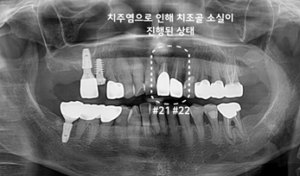 앞니 브릿지 치료