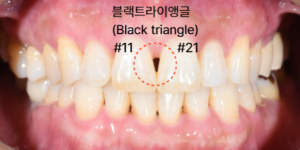블랙트라이앵글 레진