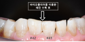 앞니 사이 공간 레진