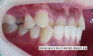 성인 반대교합 교정