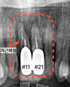 상악 전치부 앞니 임플란트 치료 