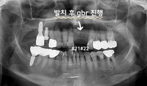 앞니 브릿지 치료