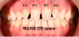 왜소치 치료
