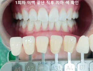 전문가 미백