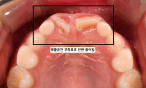 어린이 반대교합 교정