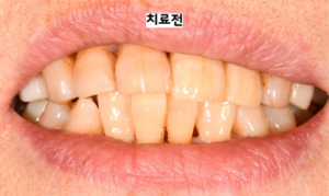 앞니 브릿지 치료