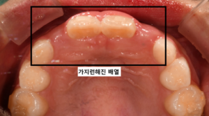 어린이 반대교합 교정