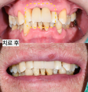 상악 전치부 앞니 임플란트 치료 