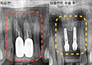 상악 전치부 앞니 임플란트 치료 