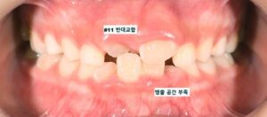 어린이 반대교합 교정