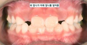 어린이 반대교합 교정