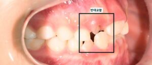 어린이 반대교합 교정
