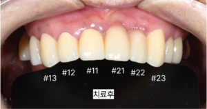 앞니 브릿지 치료