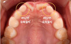 어린이 반대교합 교정
