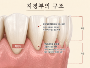 치경부 레진 치료