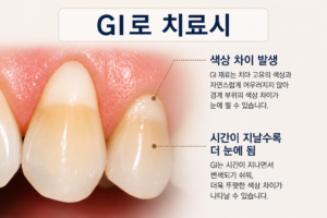 치경부 레진 치료