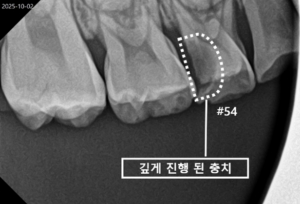 공간유지장치
