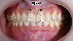 앞니 벌어짐 레진