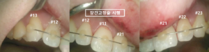 앞니 재이식