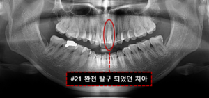 앞니 재이식