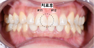 앞니 벌어짐 레진