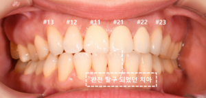 앞니 재이식