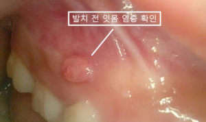 공간유지장치