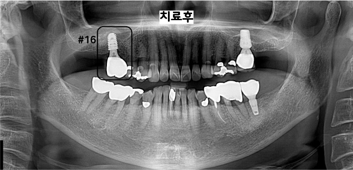서울랩치과 동일 환자의 위 어금니 · 상악동 치료 후 기록, 2026.06.11