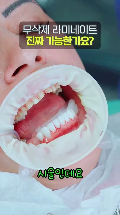 무삭제 라미네이트가 가능할까요?