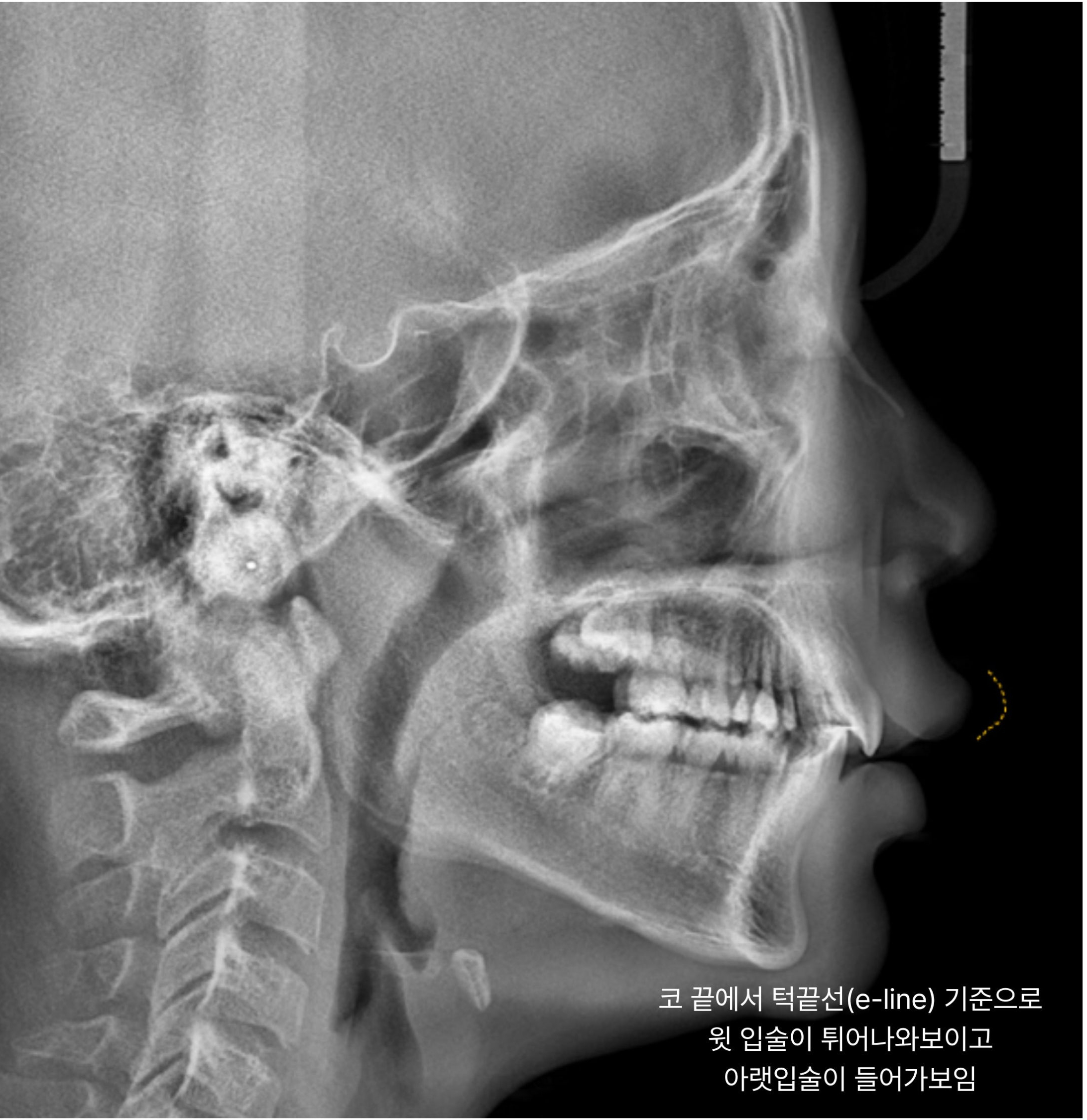 프리올소 교정 전 측모 방사선 사진 — 아래턱 위치와 앞니 전후 간격