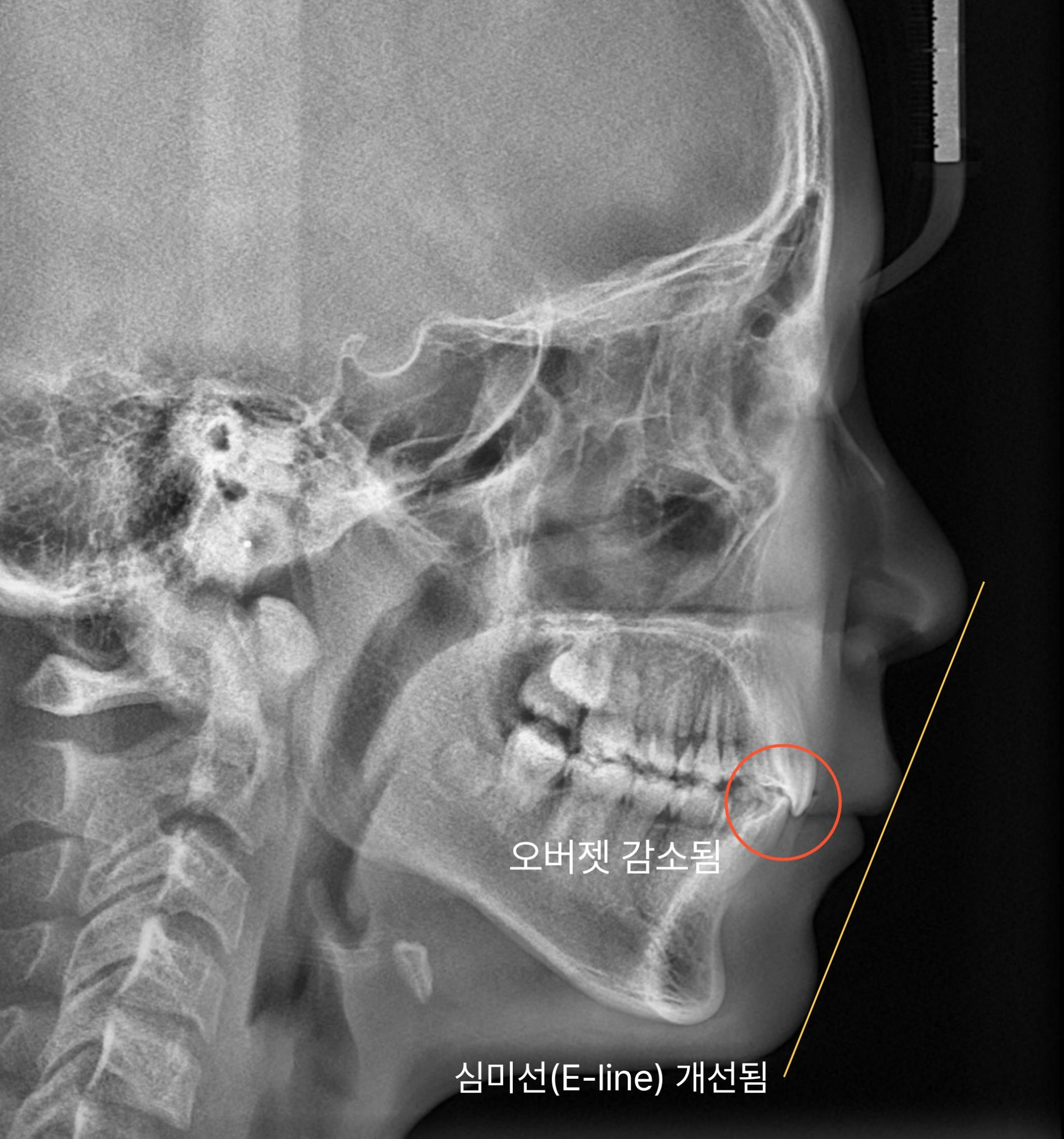 프리올소 교정 후 측모 방사선 사진 — 입매와 앞니 전후 간격의 변화