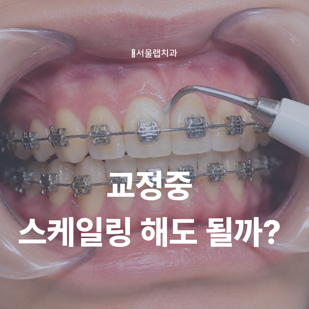 교정 중 스케일링 안 하면 생기는 문제 5가지