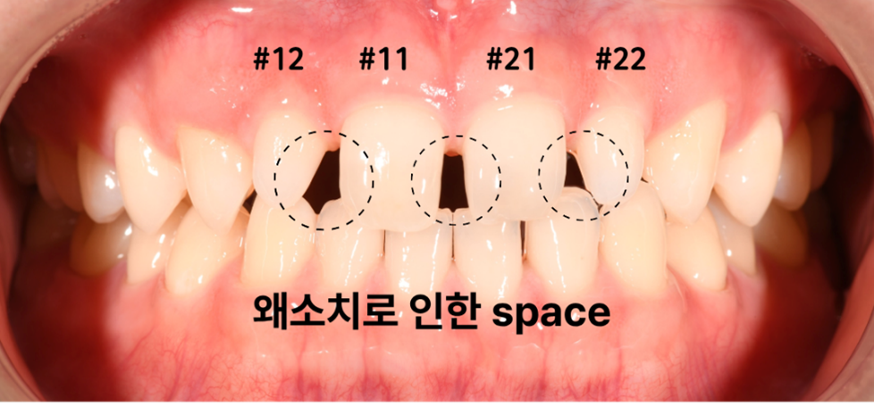 왜소치 전치부 크라운 치료 전 임상 사진