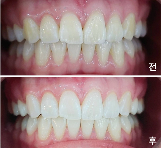 자가미백 효과 부족으로 시작한 전문가미백 1회차 치료사례-서울랩치과