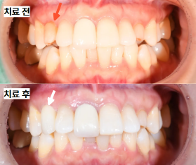 송곳니 임플란트, 선천적 영구치 결손으로 남아 있던 유치 발치 후 회복 사례-서울랩치과