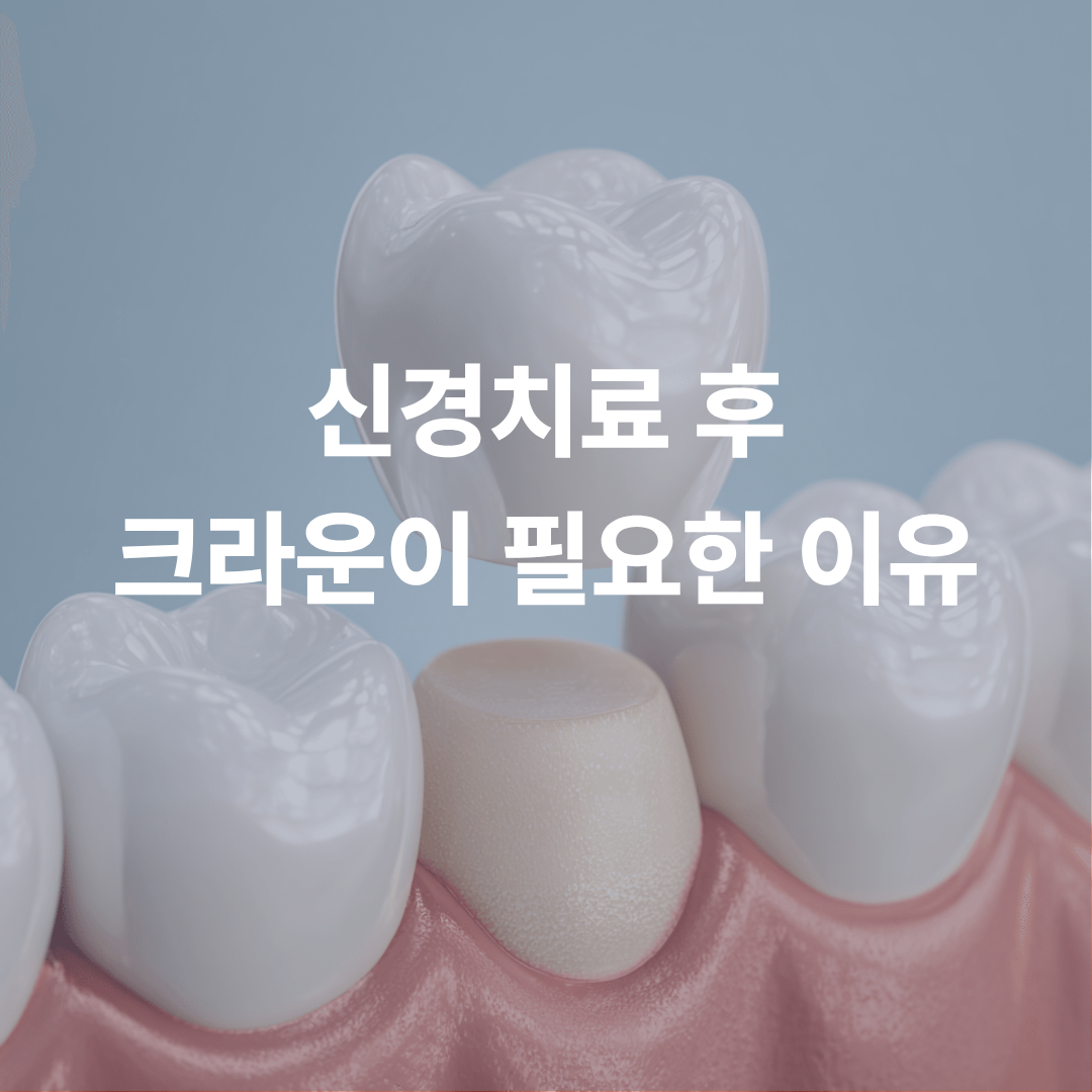 신경치료 후 크라운을 바로 해야 하는 이유