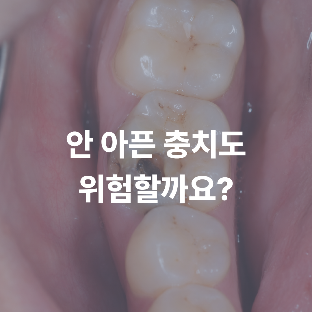 어금니 충치, 통증 없을 때 치료가 중요한 이유