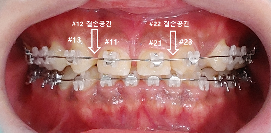 앞니 결손 지르코니아 브릿지 치료 전 임상 사진