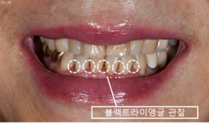 앞니 사이 공간,블랙트라이앵글,바이오클리어