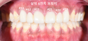 앞니 브릿지