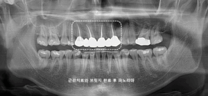 앞니 브릿지
