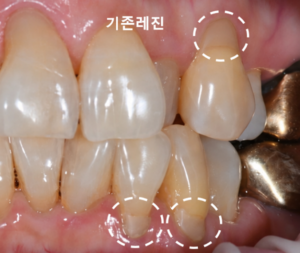 앞니와 아래 치아의 기존 레진 중 유지하기로 한 부위를 표시한 구강 사진